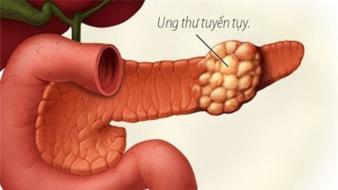 Bạn sẽ có những biểu hiện này khi ung thư tụy tiến triển - 1 Bạn sẽ có những biểu hiện này khi ung thư tụy tiến triển - 1