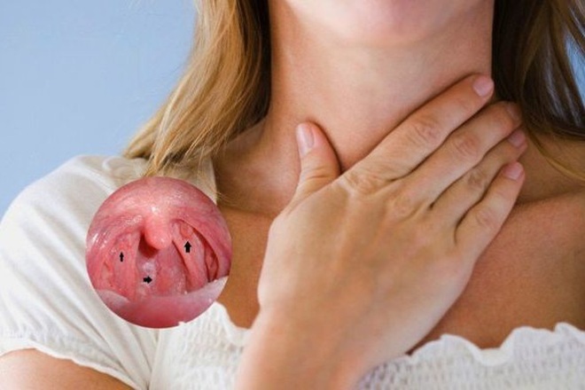 Ung thư vòm họng: Dấu hiệu nhận biết và cách tầm soát - 1