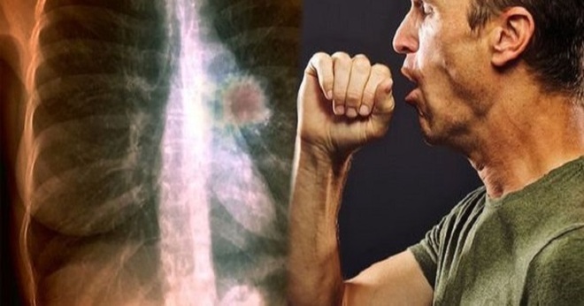 Các dấu hiệu và triệu chứng ban đầu của ung thư phổi - 1