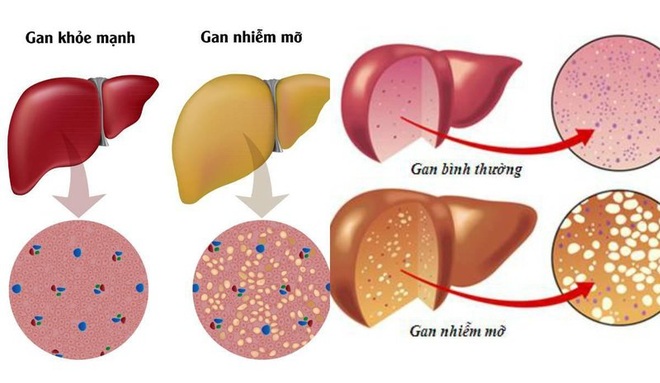 Hai biến chứng nguy hiểm của gan nhiễm mỡ - 1