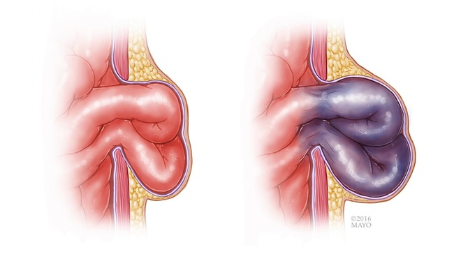 Quý ông suýt mất đoạn ruột vì đau vùng kín nhưng ngại đi khám - 1