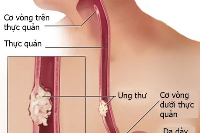 Những dấu hiệu nào cảnh báo ung thư thực quản? - 1 Những dấu hiệu nào cảnh báo ung thư thực quản? - 1