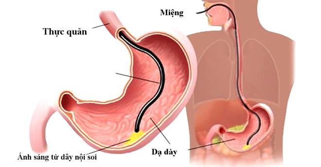 Nội soi dạ dày có ý nghĩa gì? - 1 Nội soi dạ dày có ý nghĩa gì? - 1