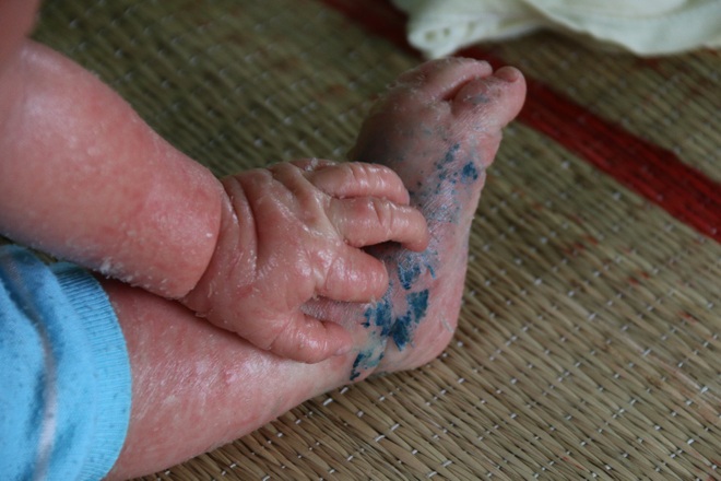 Quặn lòng bé gái da rụng như vảy cá khô, khóc thảm thiết trong đau đớn! - 9 Quặn lòng bé gái da rụng như vảy cá khô, khóc thảm thiết trong đau đớn! - 9