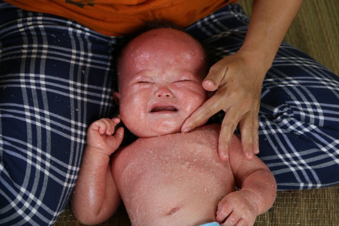 Quặn lòng bé gái da rụng như vảy cá khô, khóc thảm thiết trong đau đớn! - 1 Quặn lòng bé gái da rụng như vảy cá khô, khóc thảm thiết trong đau đớn! - 1