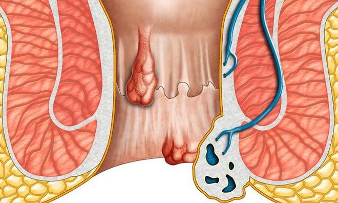 Những điều cần biết về ung thư hậu môn - 1 Những điều cần biết về ung thư hậu môn - 1