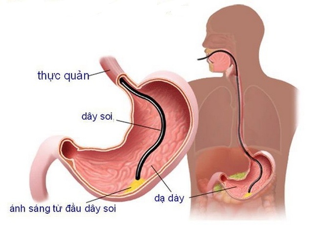 Nội soi dạ dày những điều cần biết - 1 Nội soi dạ dày những điều cần biết - 1