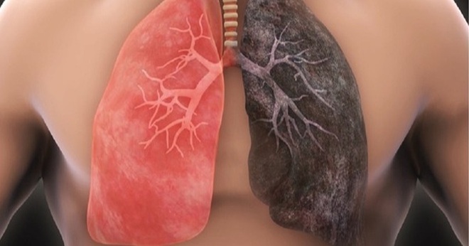 Các triệu chứng sớm cảnh báo ung thư phổi - 1