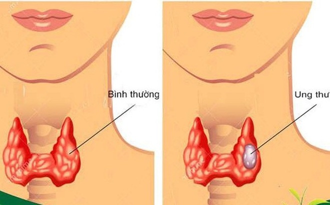 Căn bệnh ung thư dễ điều trị nhưng khó phát hiện sớm - 1