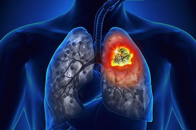 Khi cơn ho có đặc điểm này, bạn cần cảnh giác với ung thư phổi - 1