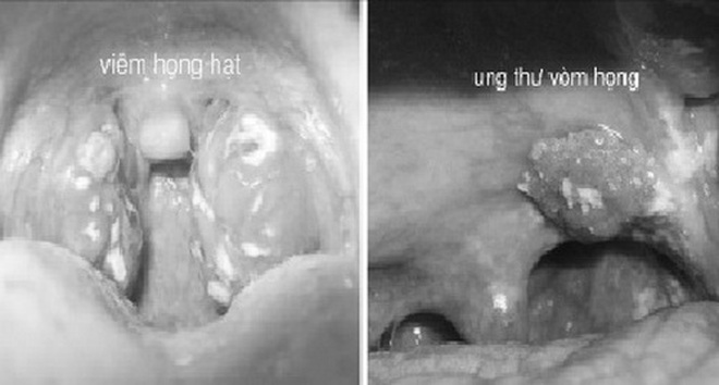 Cách phân biệt ung thư vòm họng và viêm họng | Báo Dân trí