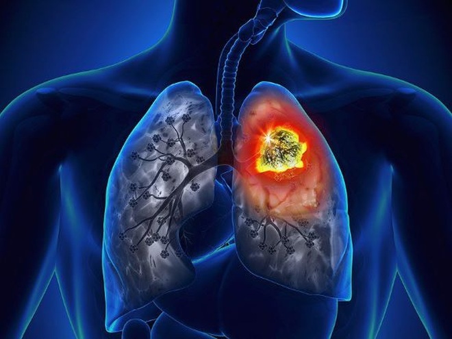 Kết hợp hóa trị và liệu pháp miễn dịch trong điều trị ung thư phổi ...