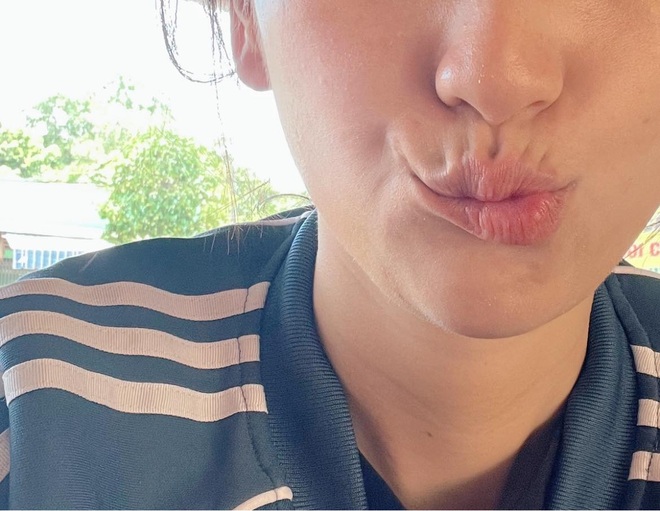 Phương Anh Đào bất ngờ chia sẻ bị lệch méo khuôn môi sau khi mổ tuyến giáp - 3 Phương Anh Đào bất ngờ chia sẻ bị lệch méo khuôn môi sau khi mổ tuyến giáp - 3