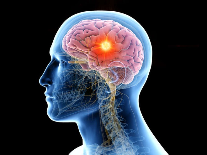 Đột phá: Xét nghiệm nước tiểu có thể phát hiện sớm khối u não