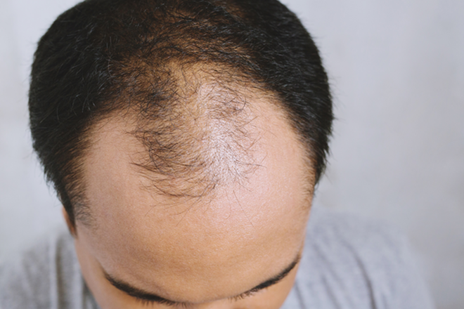 Nguyên nhân và cách khắc phục rụng tóc từng mảng hiệu quả