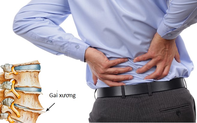 Nhiều người trẻ bị gai cột sống thắt lưng mà không hay biết - 1