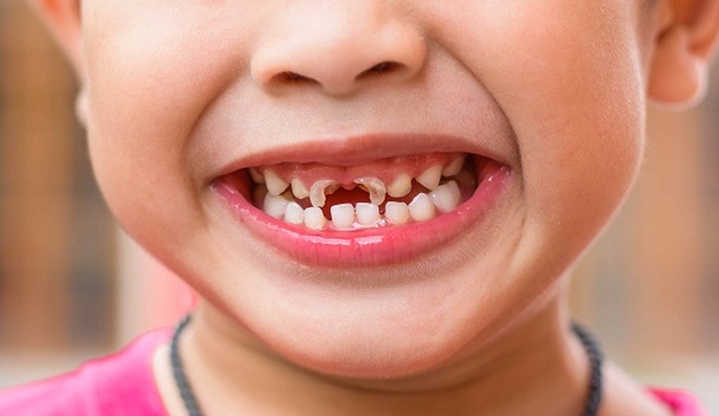 Midkid - giải pháp mới giúp chăm sóc hàm răng xinh của trẻ | Báo ...