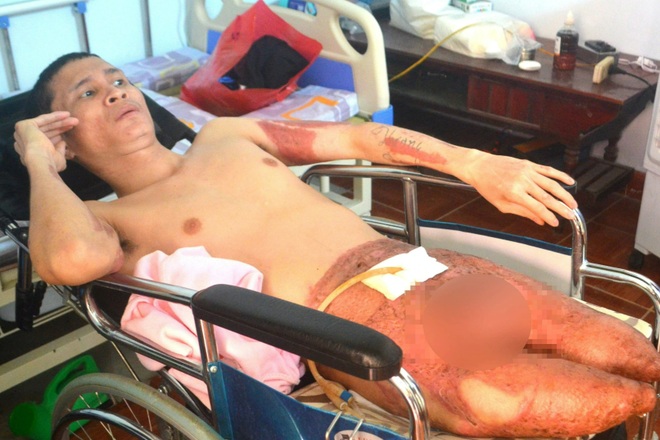 Người đàn ông chết mòn trên xe lăn: Bạn đọc giúp đỡ mua chân giả để đi lại - 2 Người đàn ông chết mòn trên xe lăn: Bạn đọc giúp đỡ mua chân giả để đi lại - 2