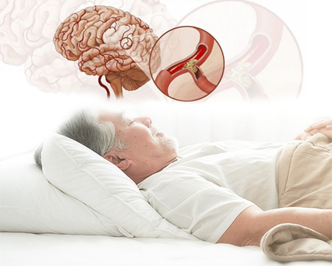 Những điều cần biết về hội chứng ngưng thở khi ngủ - 1