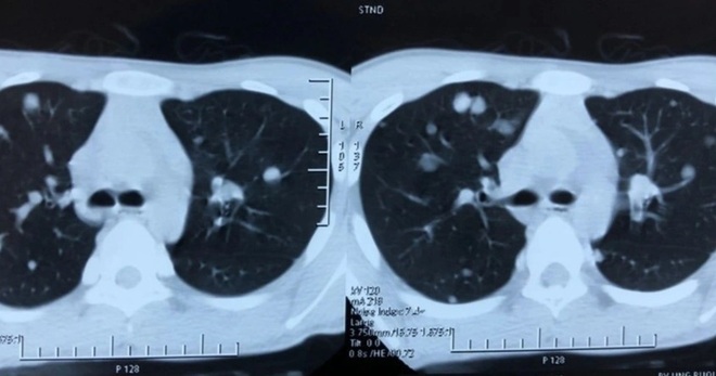 Thiếu niên 15 tuổi ung thư tuyến giáp di căn phổi - 1