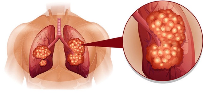 Dấu hiệu nhận biết sớm ung thư phổi - 1