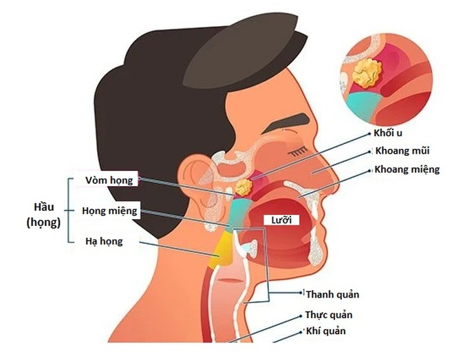 Chẩn đoán ung thư vòm họng bằng cách nào? - 1 Chẩn đoán ung thư vòm họng bằng cách nào? - 1