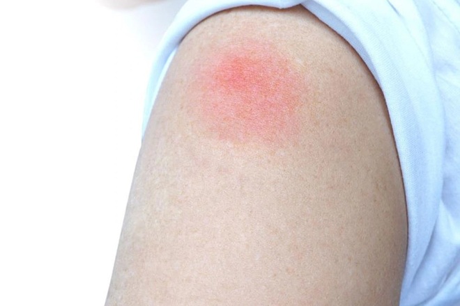 Hỏi đáp vắc xin Covid-19: Sưng đau hạch bạch huyết sau tiêm có đáng ngại? - 1 Hỏi đáp vắc xin Covid-19: Sưng đau hạch bạch huyết sau tiêm có đáng ngại? - 1