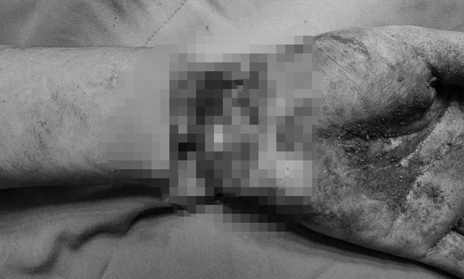 Chàng trai bị dao tự chế chém gần lìa cổ tay trái ở Tây Ninh - 1