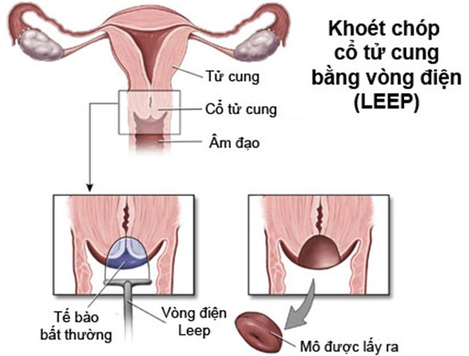 Trường hợp nào được chỉ định làm khoét chóp cổ tử cung? - 1