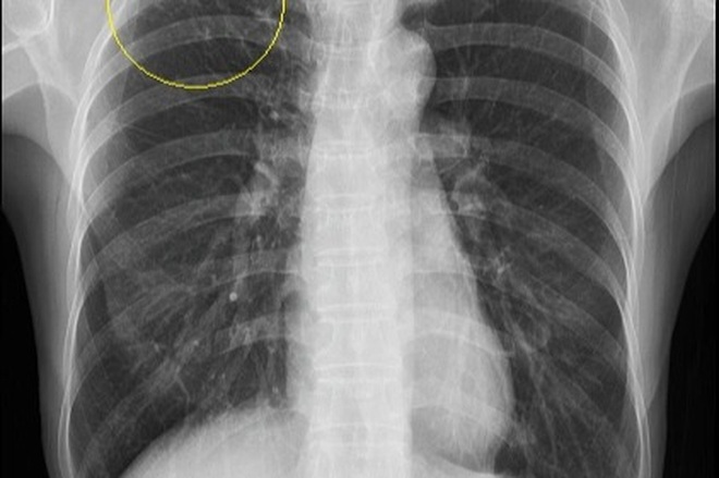 Nốt mờ ở phổi có nguy hiểm không? - 1 Nốt mờ ở phổi có nguy hiểm không? - 1