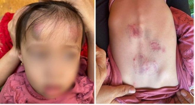 Bé gái mầm non bị bạn đánh, đạp thâm tím tại lớp, cô giáo không biết - 1 Bé gái mầm non bị bạn đánh, đạp thâm tím tại lớp, cô giáo không biết - 1
