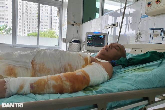 Thương người đàn ông cháy như bó đuốc sau cú phóng điện cao thế oan nghiệt - 4 Thương người đàn ông cháy như bó đuốc sau cú phóng điện cao thế oan nghiệt - 4