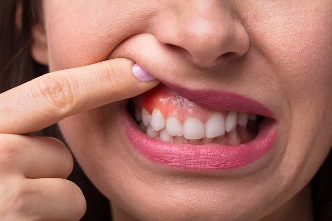 Ung thư nướu răng: Dấu hiệu và cách phòng bệnh | Báo Dân trí