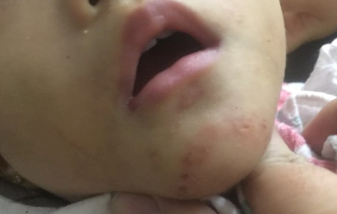 Bé 16 tháng được nhận nuôi, cơ thể có vết cắn: Người cắn là... anh nuôi? - 1 Bé 16 tháng được nhận nuôi, cơ thể có vết cắn: Người cắn là... anh nuôi? - 1