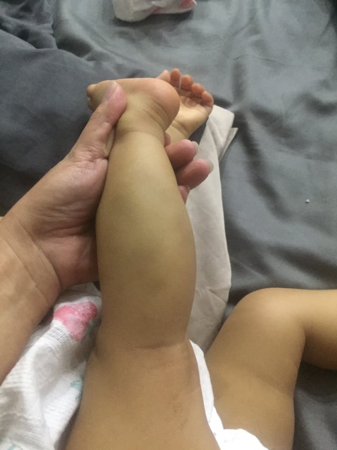 Bé 16 tháng được nhận nuôi, cơ thể có vết cắn: Người cắn là... anh nuôi? - 2 Bé 16 tháng được nhận nuôi, cơ thể có vết cắn: Người cắn là... anh nuôi? - 2