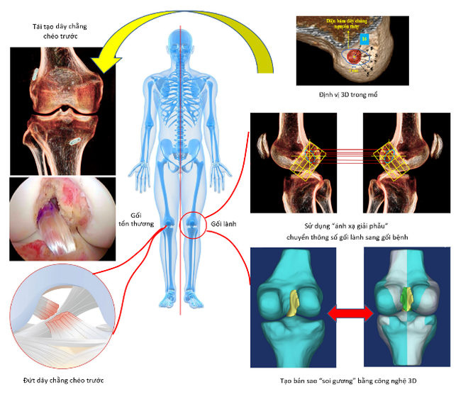 Vinmec tái tạo chính xác dây chằng chéo trước khớp gối với phương pháp ánh xạ giải phẫu độc quyền - 3 Vinmec tái tạo chính xác dây chằng chéo trước khớp gối với phương pháp ánh xạ giải phẫu độc quyền - 3