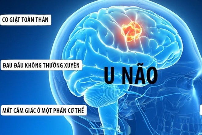 U não ác tính có thể ảnh hưởng đến các chức năng thần kinh như thế nào?
