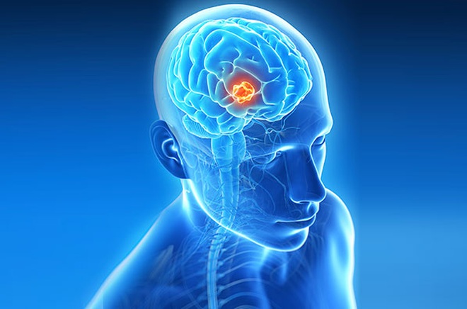 Tình trạng động kinh có thể liên quan đến u não lành tính không?
