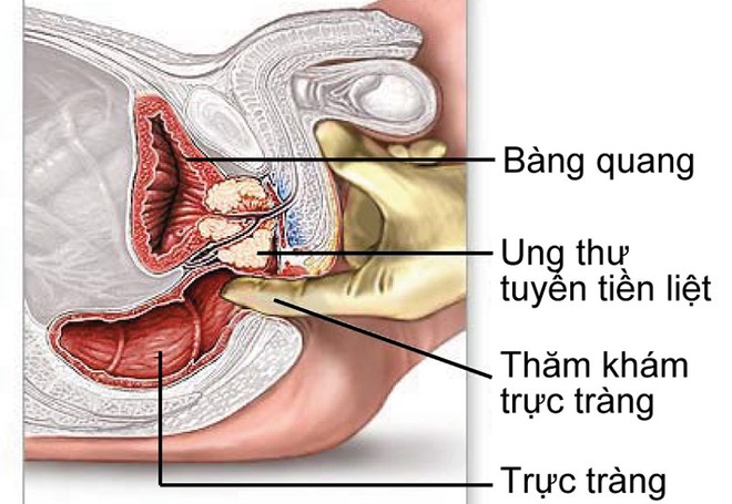 Dấu hiệu ung thư tiền liệt tuyến dễ nhầm với phì đại thông thường - 1