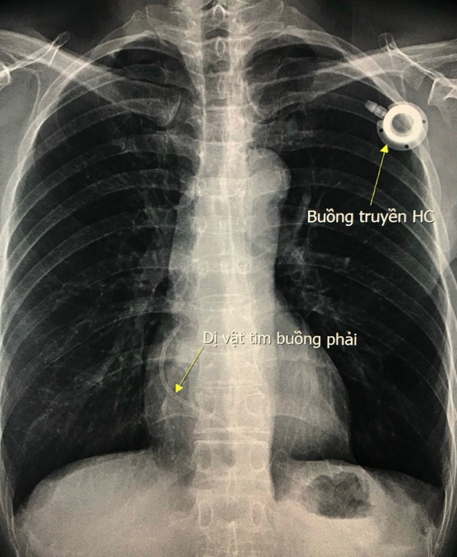 Lấy dị vật kẹt trong tim cho người bệnh ung thư vú - 1 Lấy dị vật kẹt trong tim cho người bệnh ung thư vú - 1