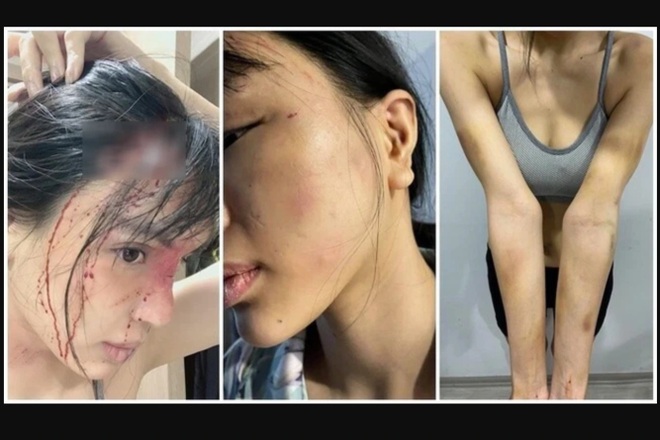 Công an điều tra nghi vấn siêu mẫu Khả Trang bị bạn trai bạo hành dã man - 1