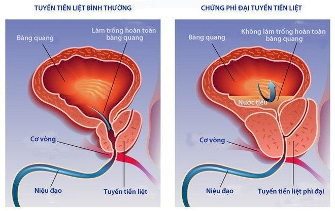 Phì đại tiền liệt tuyến: Nguyên nhân, triệu chứng và cách xử lý - 2 Phì đại tiền liệt tuyến: Nguyên nhân, triệu chứng và cách xử lý - 2