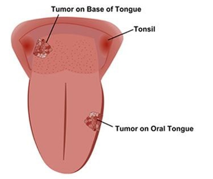 Dấu hiệu cảnh báo ung thư lưỡi giai đoạn cuối - 1