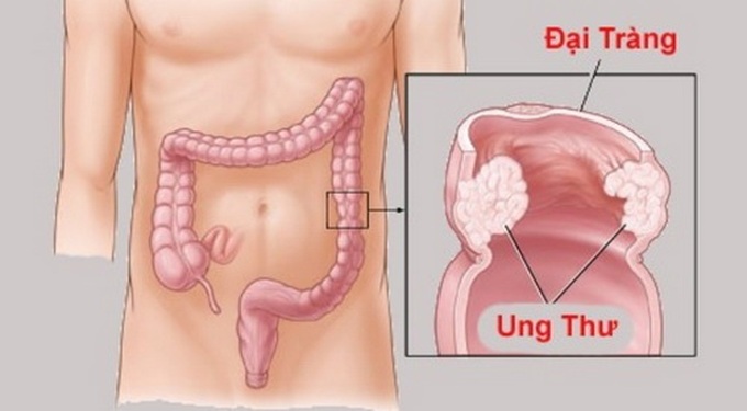 Cách phòng ngừa ung thư đại tràng
