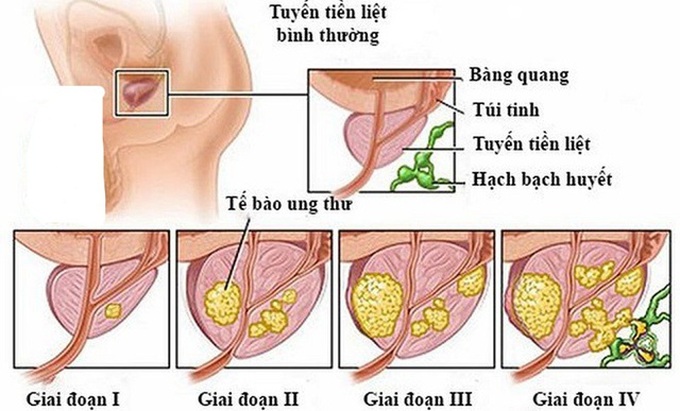 5 bệnh ung thư thường gặp ở nam giới - 5