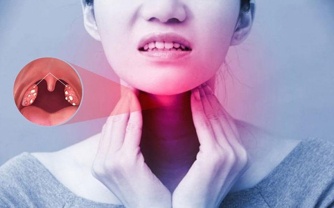 Chấm dứt khổ sở do viêm Amidan nhiều lần - 1 Chấm dứt khổ sở do viêm Amidan nhiều lần - 1