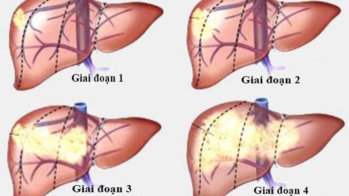 Ung thư gan giai đoạn 4: Điều gì sẽ xảy ra? - 2