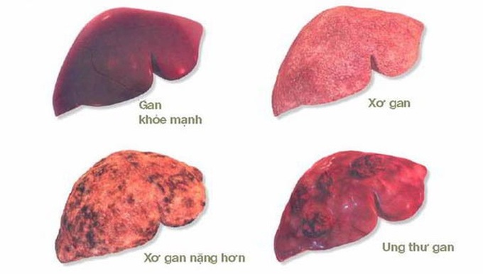 Chủ quan với biểu hiện này, người đàn ông bị ung thư di căn gan - 2