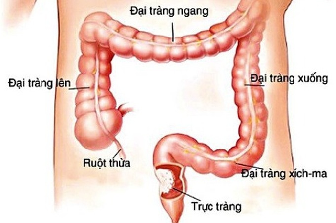 Các triệu chứng của bệnh ung thư trực tràng là gì? - 1