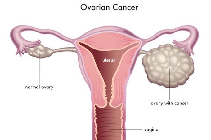 Ung thư buồng trứng giai đoạn 3